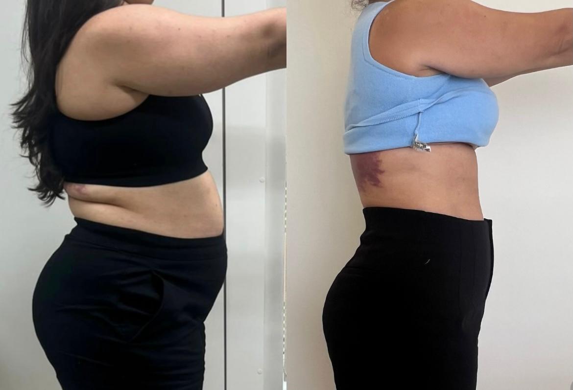 Antes e depois de paciente com o Método PESE